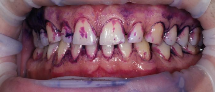 Disclosed biofilm in the Guided Biofilm Therapy protocol