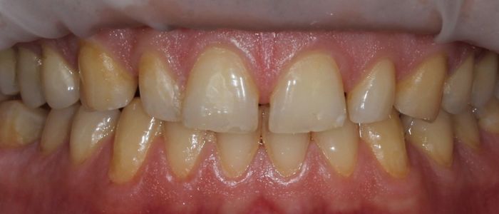 Teeth before biofilm disclosing