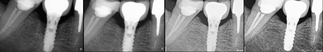 Non-surgical management of peri-implantitis: radiographic follow-up 2020–2025